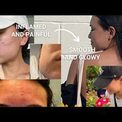 How I Cleared My Skin From The Inside Out | nutrition, supplements, products, etc.
