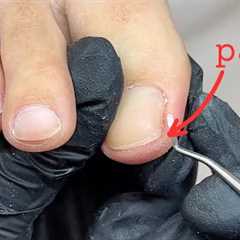 Pain there does not always mean ingrown toenails...! [Pro Nail Tech explains]