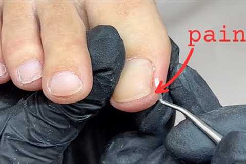 Pain there does not always mean ingrown toenails...! [Pro Nail Tech explains]